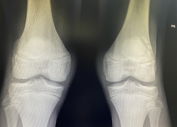 Figura 1. Radiografía anteroposterior de rodilla bilateral. 
