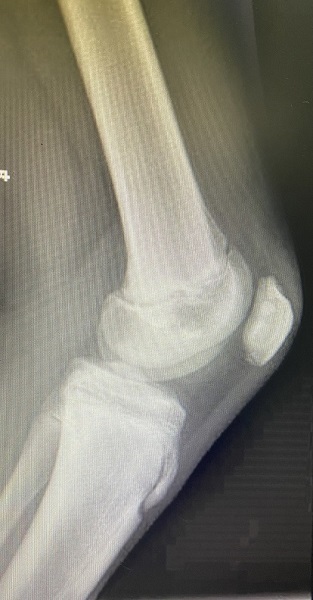 Figura 2. Radiografía lateral de la rodilla izquierda.