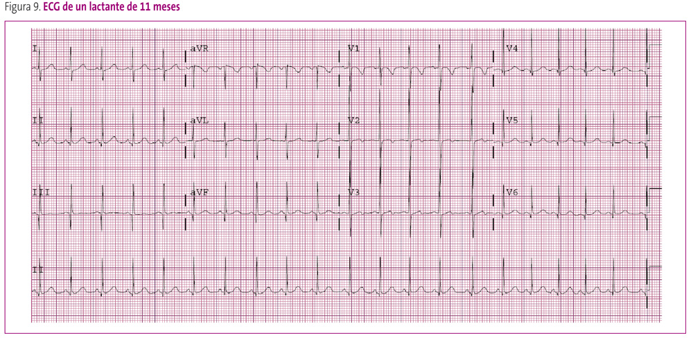 Figura 9. ECG de un lactante de 11 meses