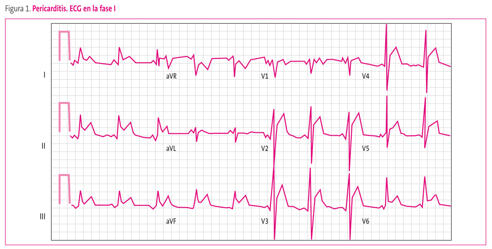 Figura 1. Pericarditis. ECG en la fase I
